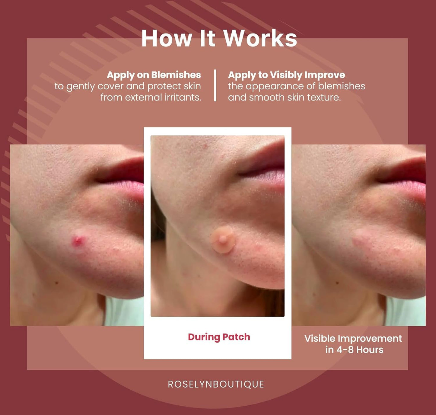 ROSELYNBOUTIQUE Pimple Patches - Hydrocolloid Spot Patches for Blemishes – 300 Clear Dots – Vegan & Cruelty-Free – Cosmetic Facial Skincare Product