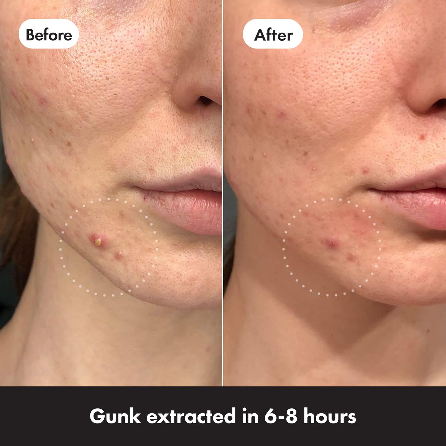 Mighty Patch Original Spot Patches by Hero Cosmetics, Day & Night Time Acne Treatment, Clear Spot Remover Hydrocolloid Patches, Anti Acne Dots, Spot Treatment Pimple Stickers - 36 Patches