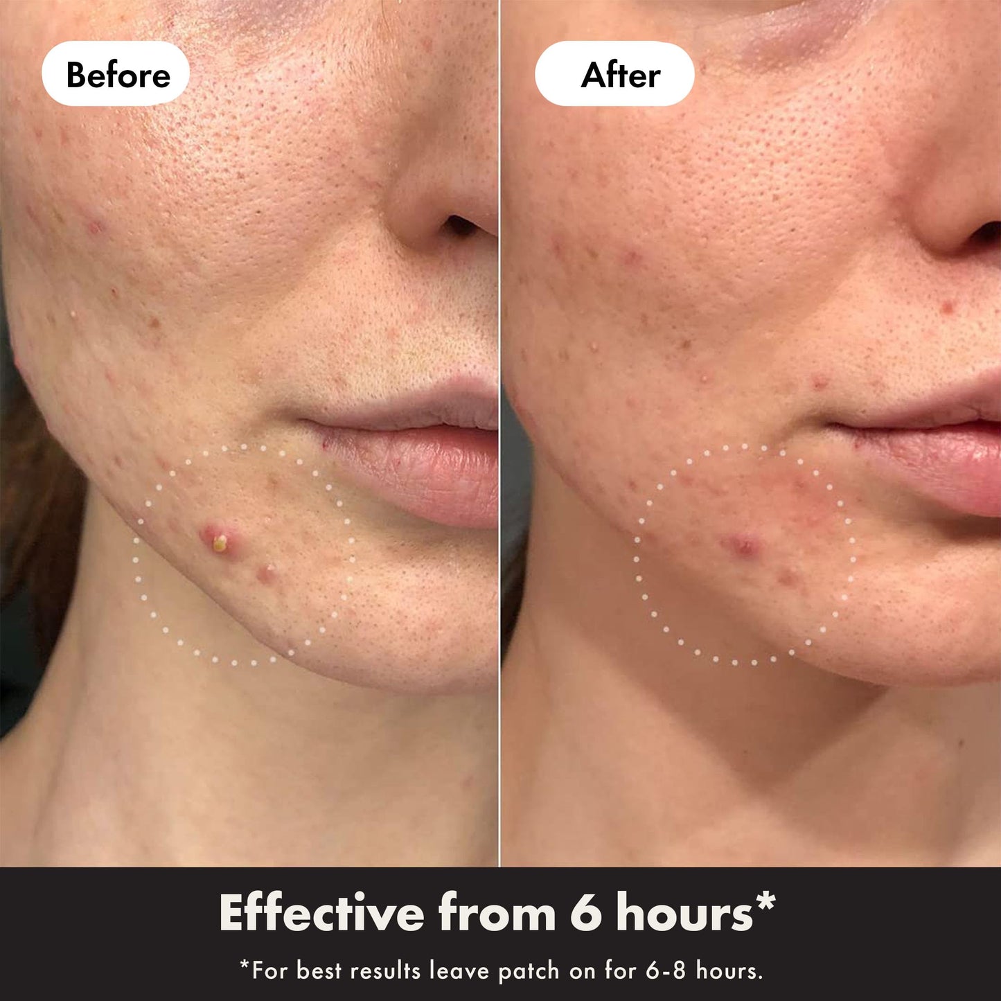 Mighty Patch Original Spot Patches by Hero Cosmetics, Day & Night Time Acne Treatment, Clear Spot Remover Hydrocolloid Patches, Anti Acne Dots, Spot Treatment Pimple Stickers - 36 Patches