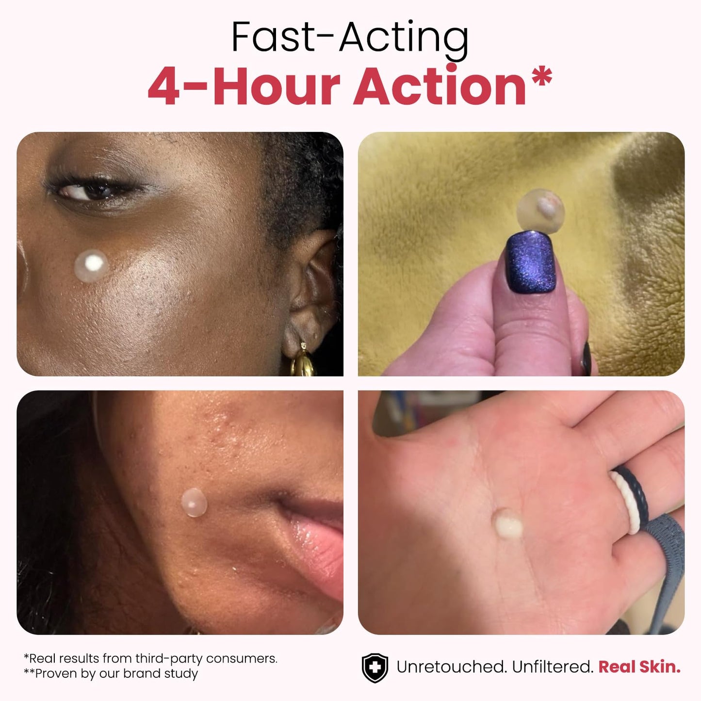 ROSELYNBOUTIQUE Pimple Patches - Hydrocolloid Spot Patches for Blemishes – 300 Clear Dots – Vegan & Cruelty-Free – Cosmetic Facial Skincare Product